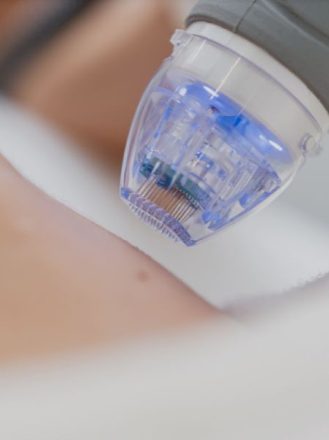 Microneedling Behandlung bei Kosmetikstudio Ringberg