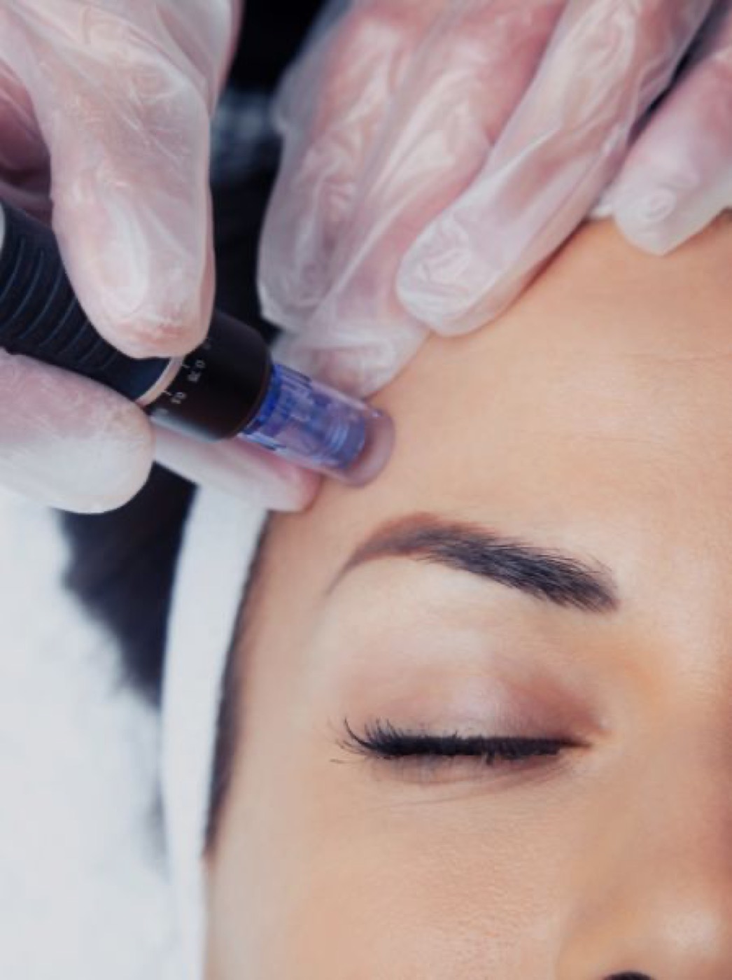 Microneedling — natürliches Lifting für straffere Haut